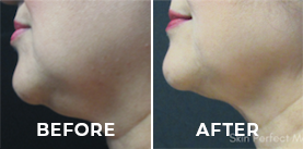 Before & After Photos CoolSculpting