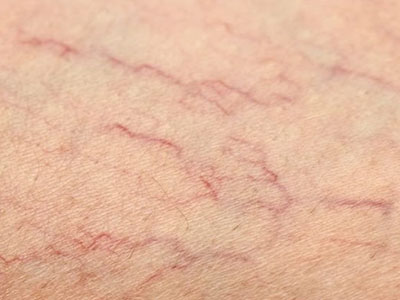 Vein Therapy Brea, Costa Mesa, Glendora, Lancaster, Rancho Cucamonga, Whittier, and West Hollywood CoolGlide vein treatments