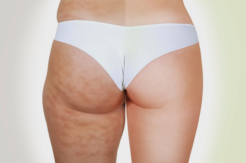 Body Contouring/Cellulite Reduction - Perfect Image Medical Spa