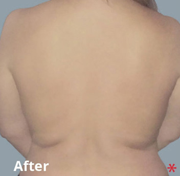 Body Before & After Patient #4260