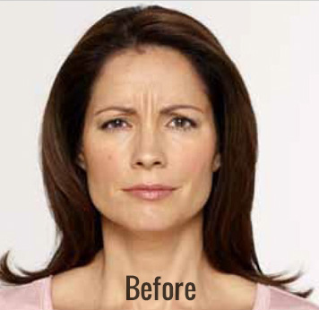 Botox Before & After Patient #4264