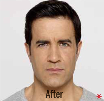 Botox Before & After Patient #4267