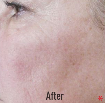 Chemical Peel Before & After Patient #4270
