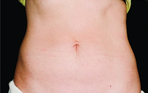 CoolSculpting Before & After Patient #4276
