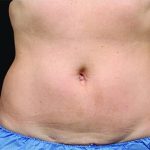CoolSculpting Before & After Patient #4283
