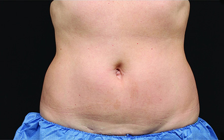 CoolSculpting Before & After Patient #4283