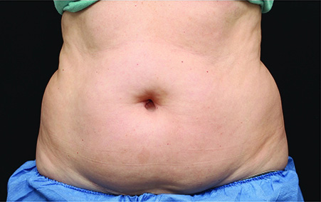 CoolSculpting Before & After Patient #4283