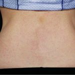 CoolSculpting Before & After Patient #4284