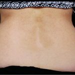 CoolSculpting Before & After Patient #4284