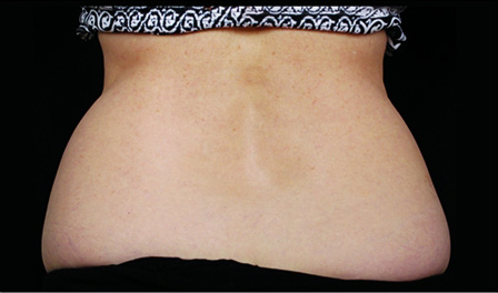 CoolSculpting Before & After Patient #4284