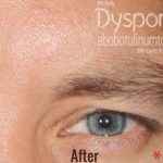 Botox, Dysport, & Xeomin Before & After Patient #4290