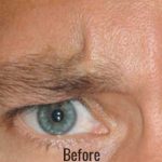 Botox, Dysport, & Xeomin Before & After Patient #4290