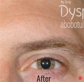 Dysport Before & After Patient #4293