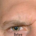 Botox, Dysport, & Xeomin Before & After Patient #4293