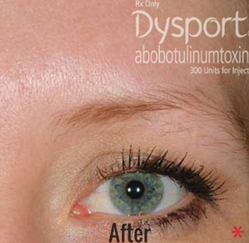 Dysport Before & After Patient #4296