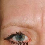 Botox, Dysport, & Xeomin Before & After Patient #4296