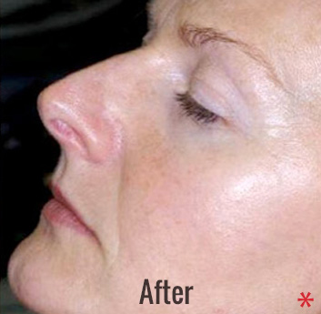 Photofacial Before & After Patient #4384