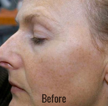 Photofacial Before & After Patient #4384