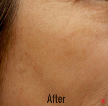 Photofacial Before & After Patient #4385