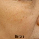 Photofacial Before & After Patient #4385