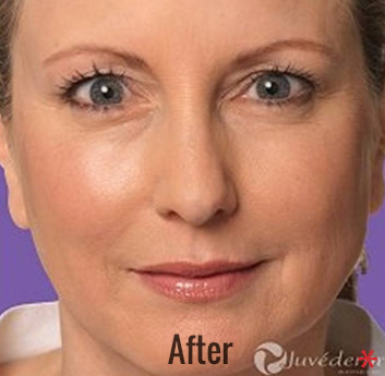 Juvederm Before & After Patient #4311