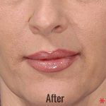 Juvederm Before & After Patient #4317