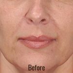 Juvederm Before & After Patient #4317
