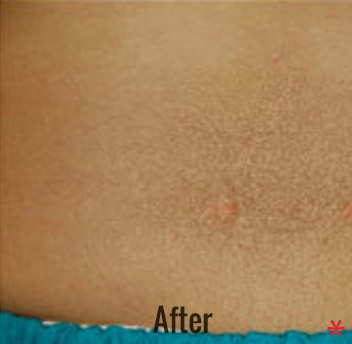 Laser Tattoo Removal Before & After Patient #4347