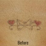 Tattoo Removal Before & After Patient #4347