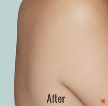 Laser Tattoo Removal Before & After Patient #4352