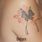 Tattoo Removal Before & After Patient #4352