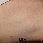 Laser Hair Removal Before & After Patient #4329