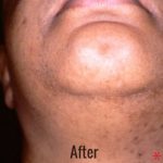 Laser Hair Removal Before & After Patient #4336
