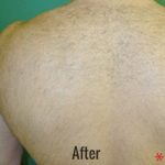 Laser Hair Removal Before & After Patient #4337