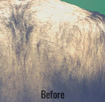 Laser Hair Removal Before & After Patient #4337