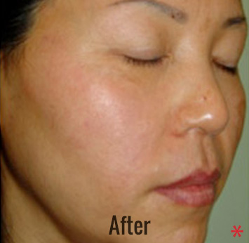 Laser Peel Toning Before & After Patient #4338