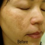 Laser Peel Toning Before & After Patient #4338