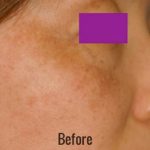 Laser Peel Toning Before & After Patient #4345