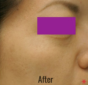 Laser Peel Toning Before & After Patient #4346