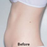CoolSculpting Before & After Patient #4353