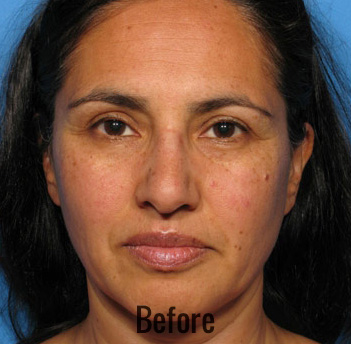 Oxygen Facial Before & After Patient #4368
