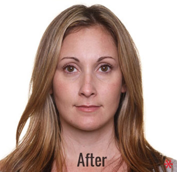 Oxygen Facial Before & After Patient #4375