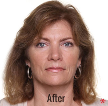 Oxygen Facial Before & After Patient #4376