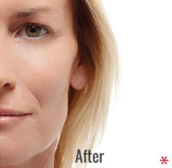 Radiesse Before & After Patient #4411