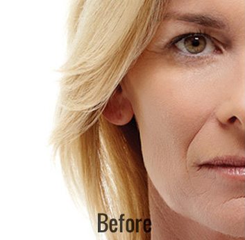 Radiesse Before & After Patient #4411