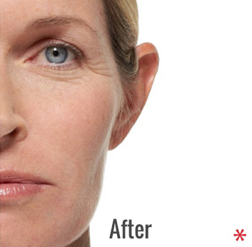 Radiesse Before & After Patient #4412