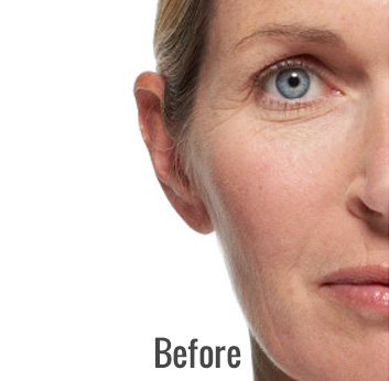 Radiesse Before & After Patient #4412