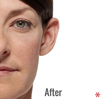 Radiesse Before & After Patient #4413