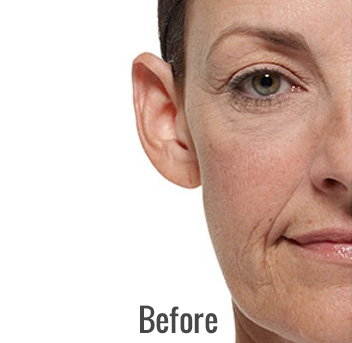 Radiesse Before & After Patient #4413