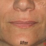 Restylane Before & After Patient #4416